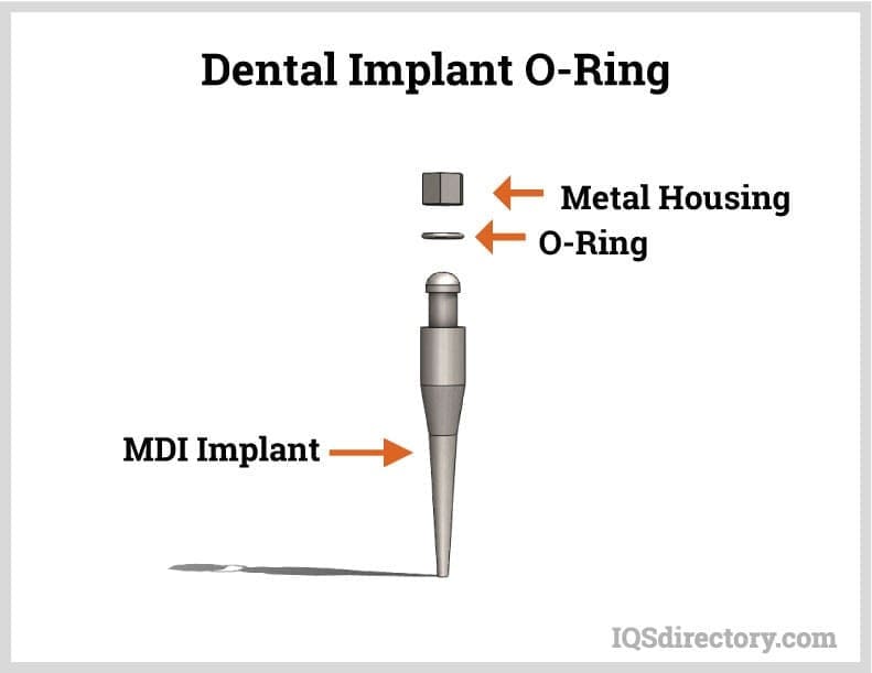 dental implant o ring